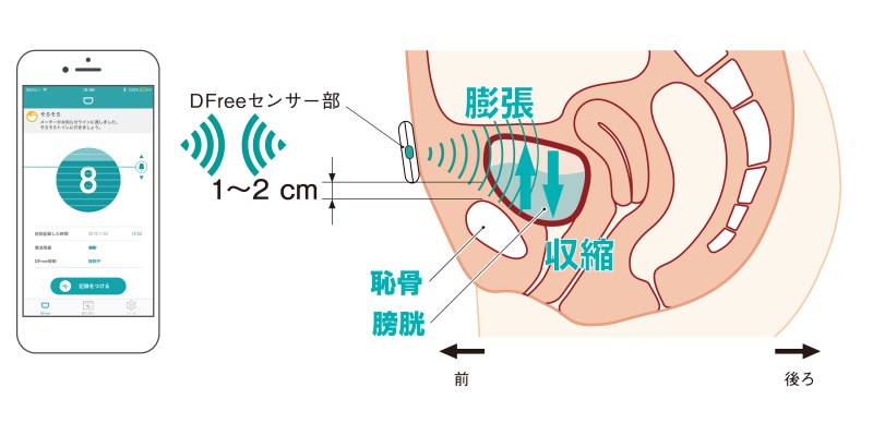 下腹部に装着したセンサーが膀胱の膨らみを常時計測。Bluetooth通信によってリアルタイムに尿の状態を把握